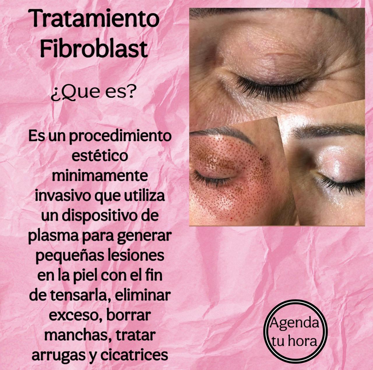 Tratamiento Fibroblast