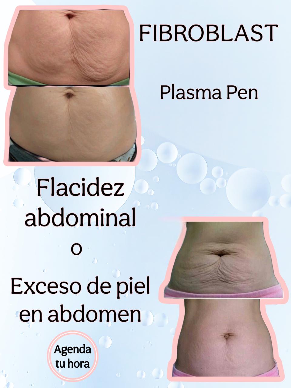 Tratamiento Fibroblast