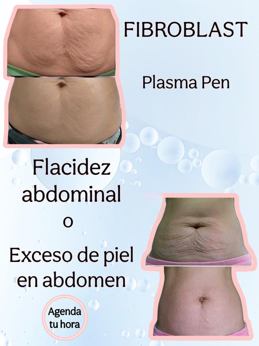Tratamiento Fibroblast