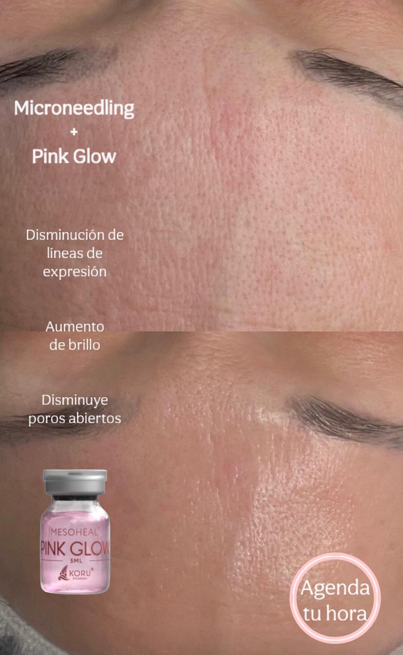 Tratamiento Pink Glow