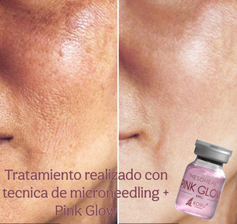 Tratamiento Pink Glow